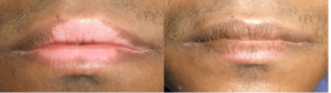 Vitiligo Treatments