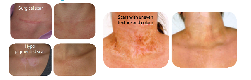 Mastectomy scarring, Areola restoration Surgical, burns and other scarring, Stretch marks and Vitiligo, Hypo pigmented scare, scars with uneven texture.