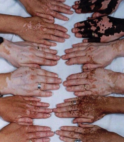 Mastectomy scarring, Areola restoration Surgical, burns & other scarring, Stretch marks and Vitiligo