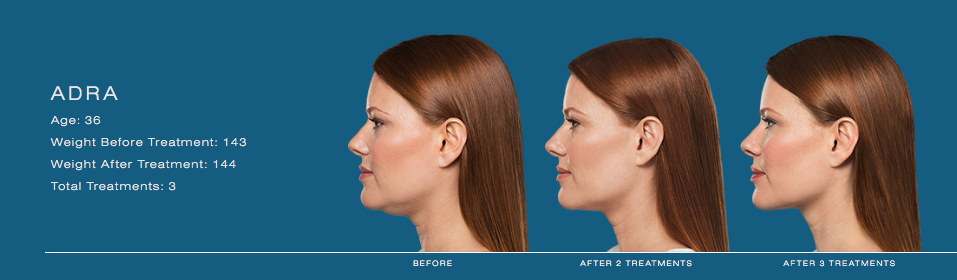 Double Chin Kybella Liposuction submental chin