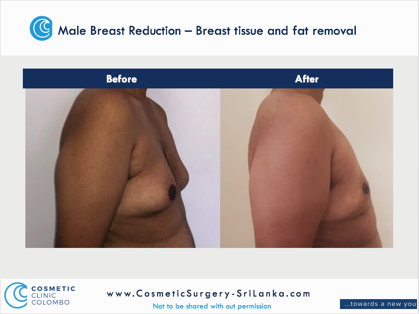 Male Breast Reduction Male Breast Reduction Gyneacomastia Gynecomastia Dr Thushan Sri Lanka Cosmetic Surgery Moobs.