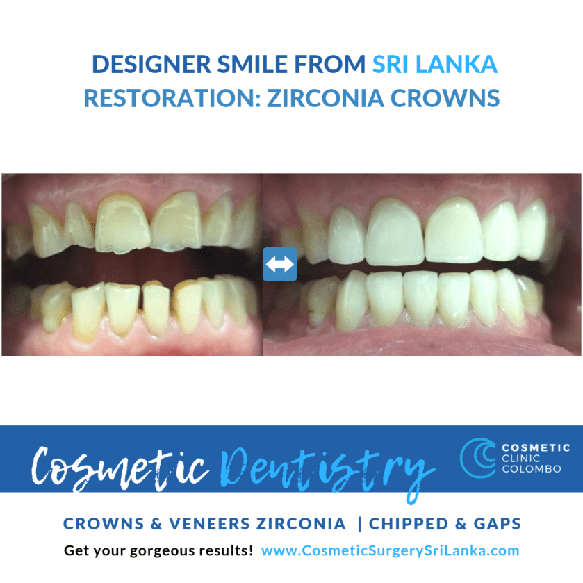 DENTAL SRI LANKA CROWNS VENEERS