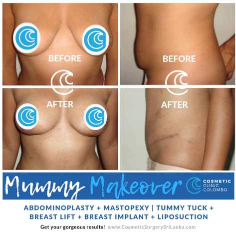 Breast lift Tummy Tuck Liposuction SRI LANKA